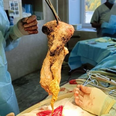 Сыктывкарские врачи извлекли из желудка 13-летней девочки волосяной шар размером с дыню