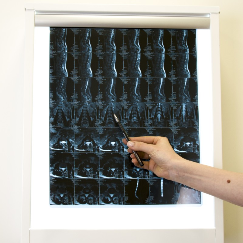 Мнение врача: для кого особенно опасны зимние переломы и как от них защититься